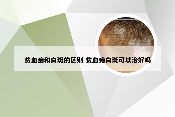 贫血痣和白斑的区别 贫血痣白斑可以治好吗