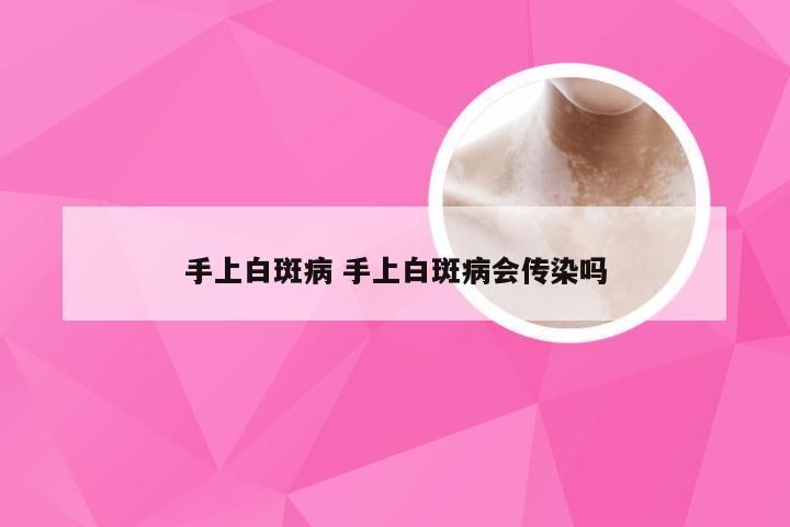 手上白斑病 手上白斑病会传染吗