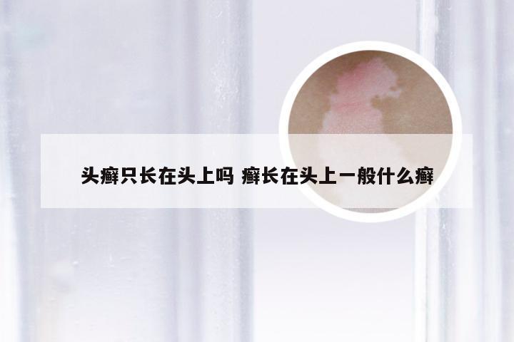 头癣只长在头上吗 癣长在头上一般什么癣