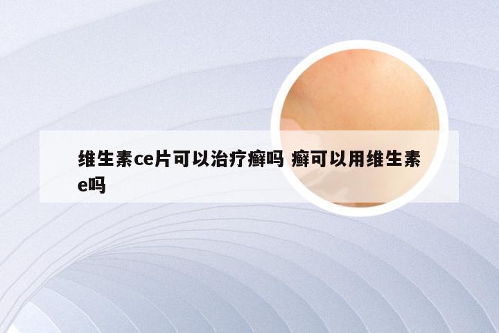 维生素ce片可以治疗癣吗 癣可以用维生素e吗