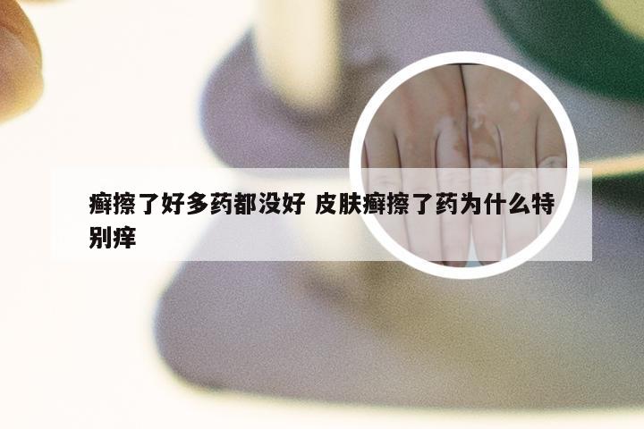 癣擦了好多药都没好 皮肤癣擦了药为什么特别痒