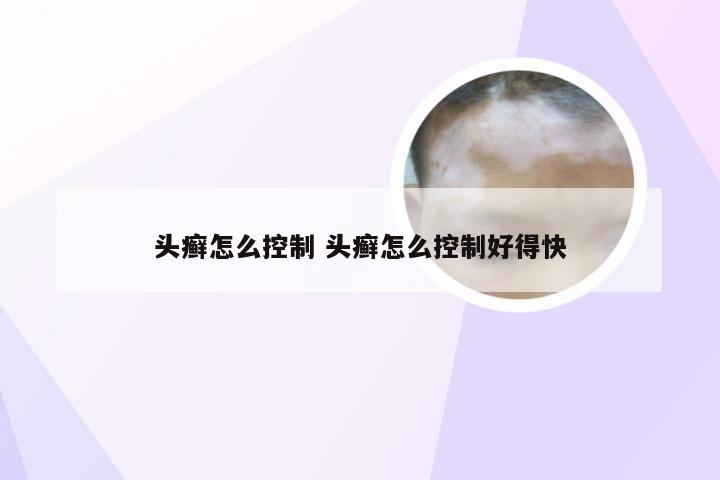 头癣怎么控制 头癣怎么控制好得快