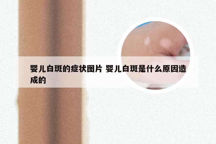 婴儿白斑的症状图片 婴儿白斑是什么原因造成的