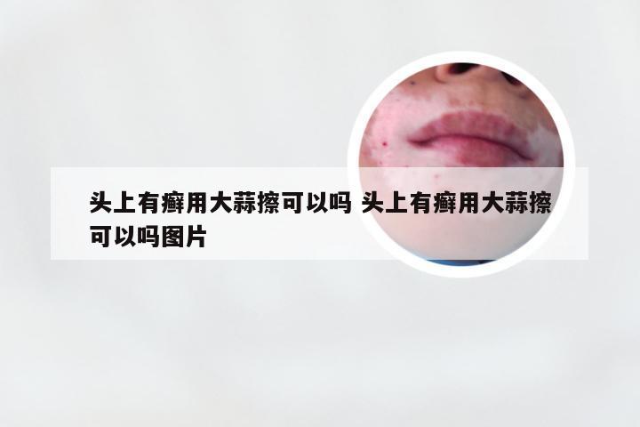 头上有癣用大蒜擦可以吗 头上有癣用大蒜擦可以吗图片