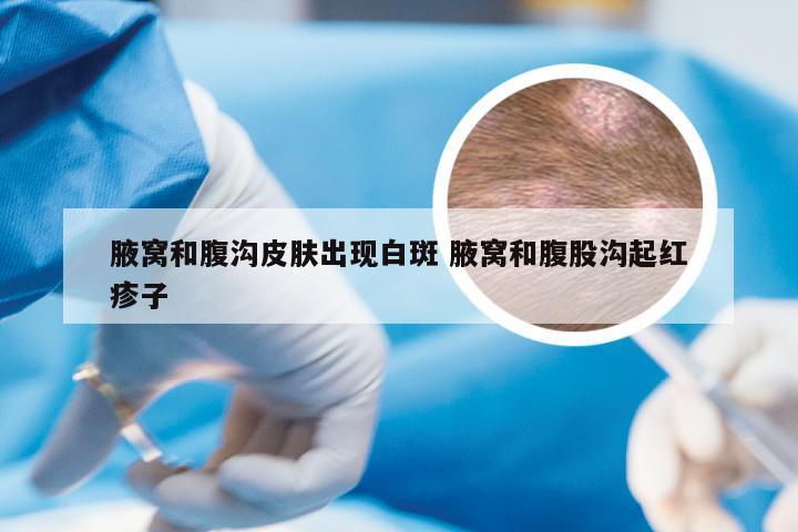 腋窝和腹沟皮肤出现白斑 腋窝和腹股沟起红疹子