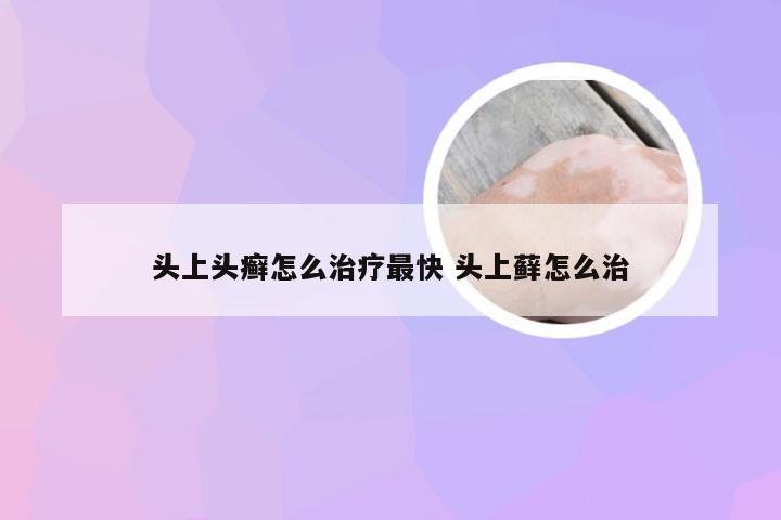 头上头癣怎么治疗最快 头上藓怎么治