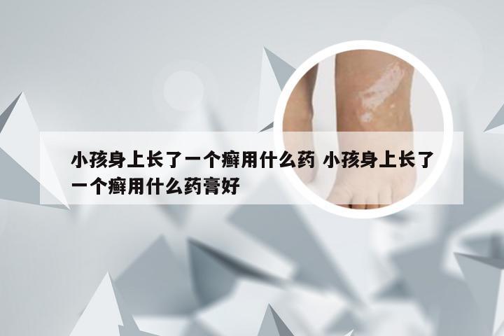 小孩身上长了一个癣用什么药 小孩身上长了一个癣用什么药膏好