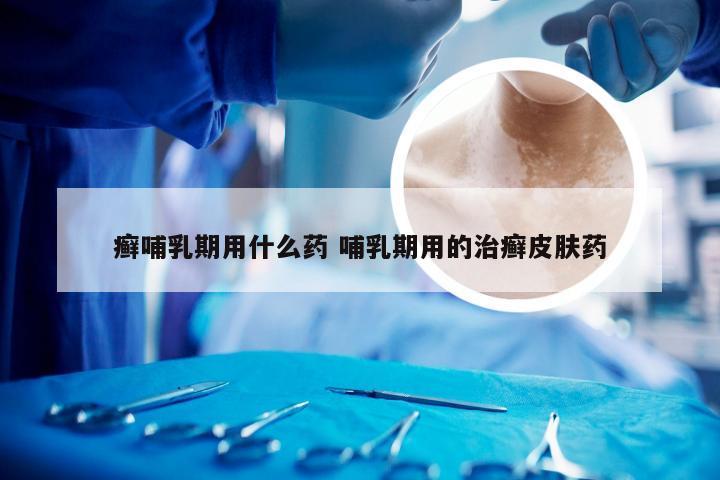 癣哺乳期用什么药 哺乳期用的治癣皮肤药