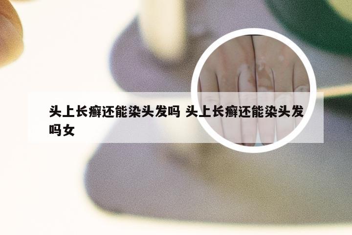 头上长癣还能染头发吗 头上长癣还能染头发吗女