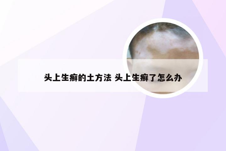 头上生癣的土方法 头上生癣了怎么办