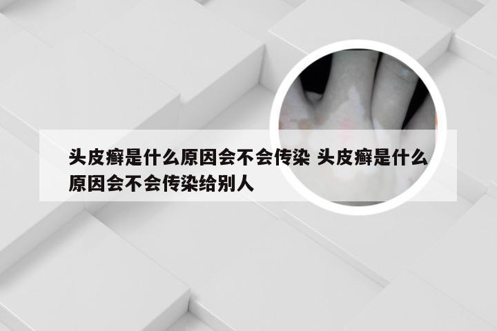 头皮癣是什么原因会不会传染 头皮癣是什么原因会不会传染给别人