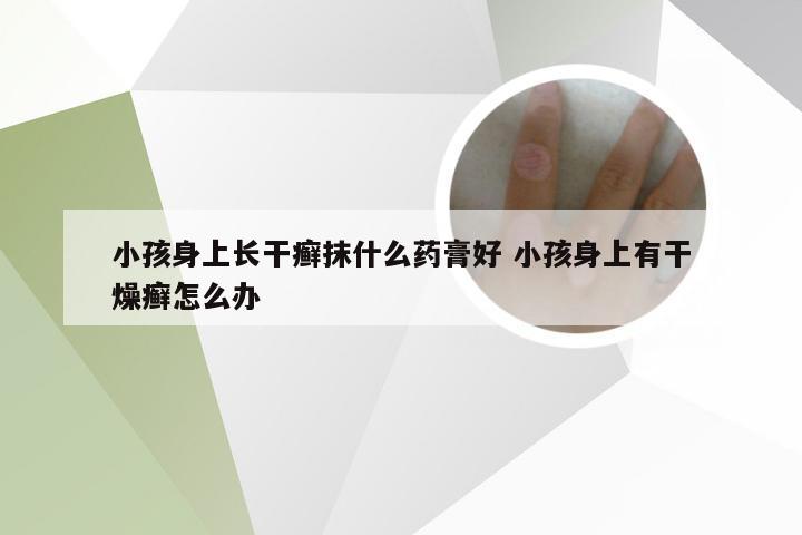 小孩身上长干癣抹什么药膏好 小孩身上有干燥癣怎么办