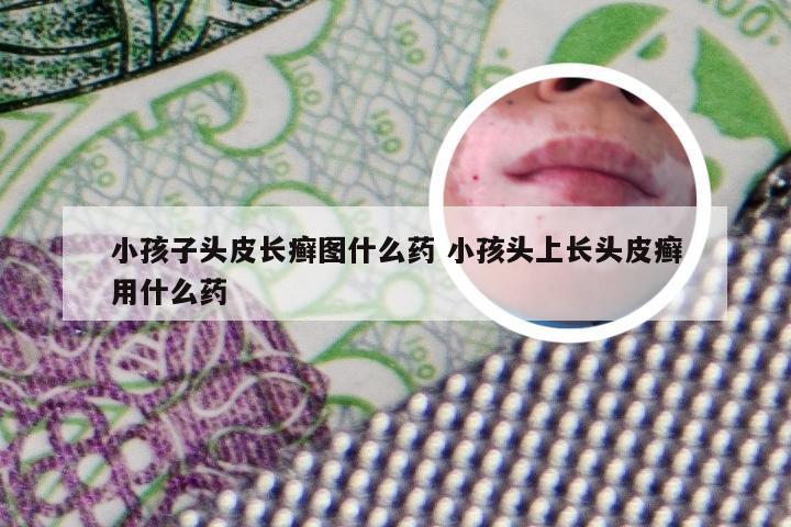 小孩子头皮长癣图什么药 小孩头上长头皮癣用什么药