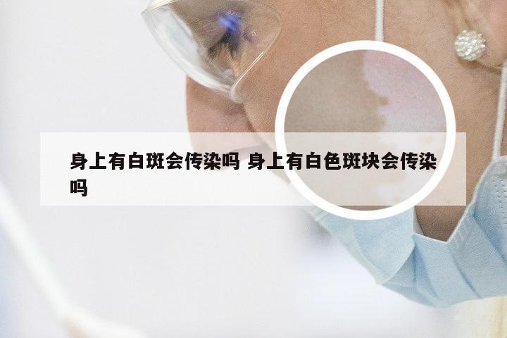 身上有白斑会传染吗 身上有白色斑块会传染吗