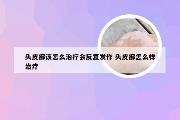 头皮癣该怎么治疗会反复发作 头皮癣怎么样治疗