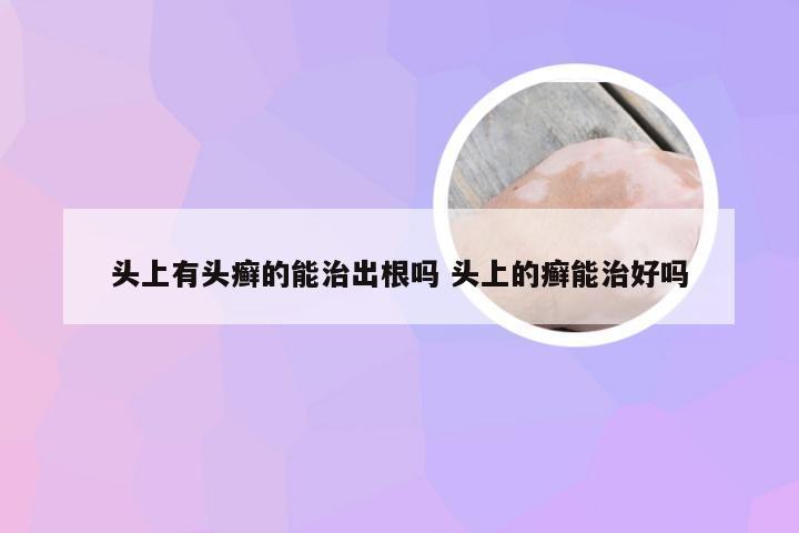 头上有头癣的能治出根吗 头上的癣能治好吗