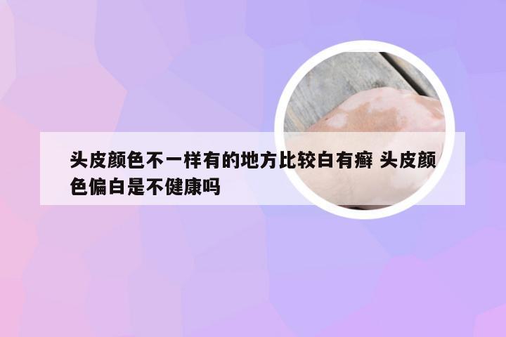 头皮颜色不一样有的地方比较白有癣 头皮颜色偏白是不健康吗