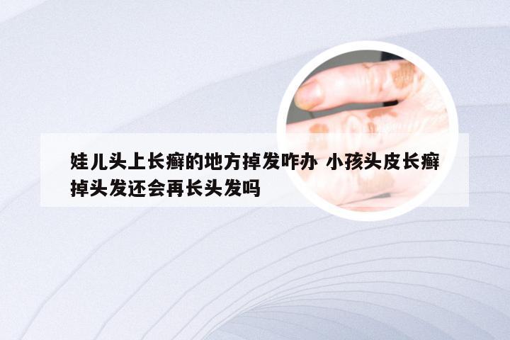 娃儿头上长癣的地方掉发咋办 小孩头皮长癣掉头发还会再长头发吗