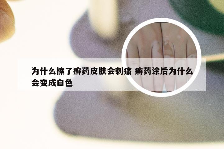 为什么檫了癣药皮肤会刺痛 癣药涂后为什么会变成白色