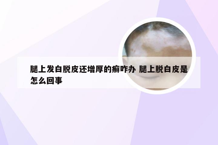 腿上发白脱皮还增厚的癣咋办 腿上脱白皮是怎么回事