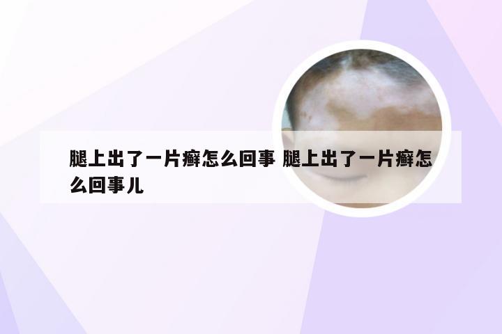 腿上出了一片癣怎么回事 腿上出了一片癣怎么回事儿