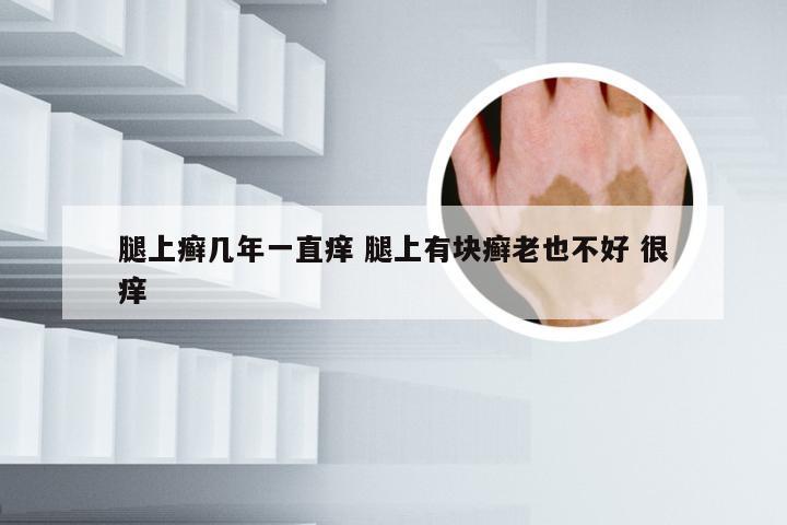 腿上癣几年一直痒 腿上有块癣老也不好 很痒