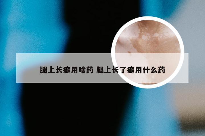 腿上长癣用啥药 腿上长了癣用什么药