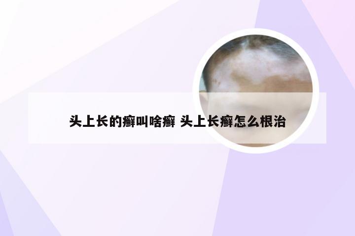 头上长的癣叫啥癣 头上长癣怎么根治