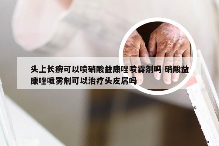 头上长癣可以喷硝酸益康唑喷雾剂吗 硝酸益康唑喷雾剂可以治疗头皮屑吗