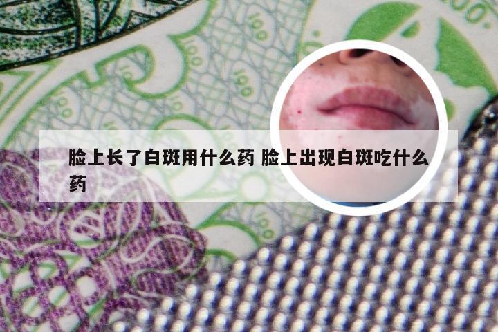 脸上长了白斑用什么药 脸上出现白斑吃什么药