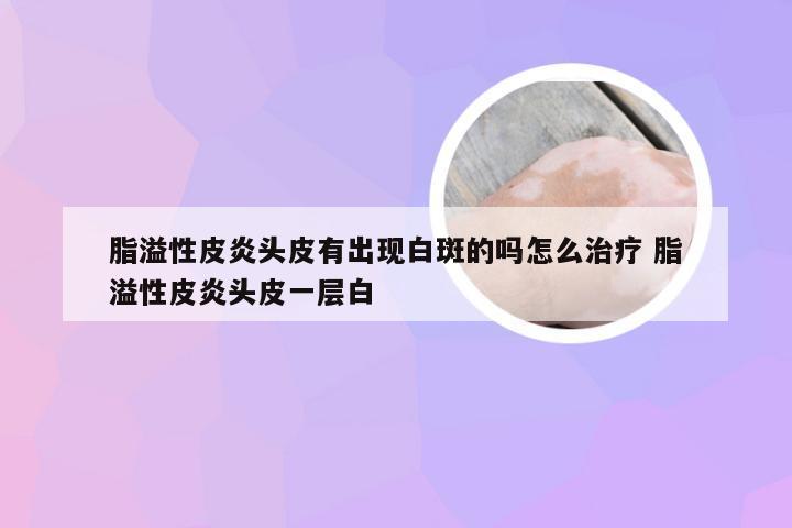 脂溢性皮炎头皮有出现白斑的吗怎么治疗 脂溢性皮炎头皮一层白