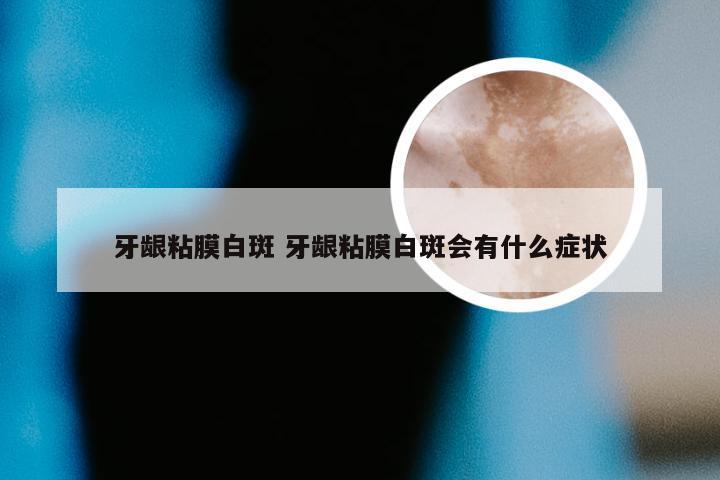 牙龈粘膜白斑 牙龈粘膜白斑会有什么症状