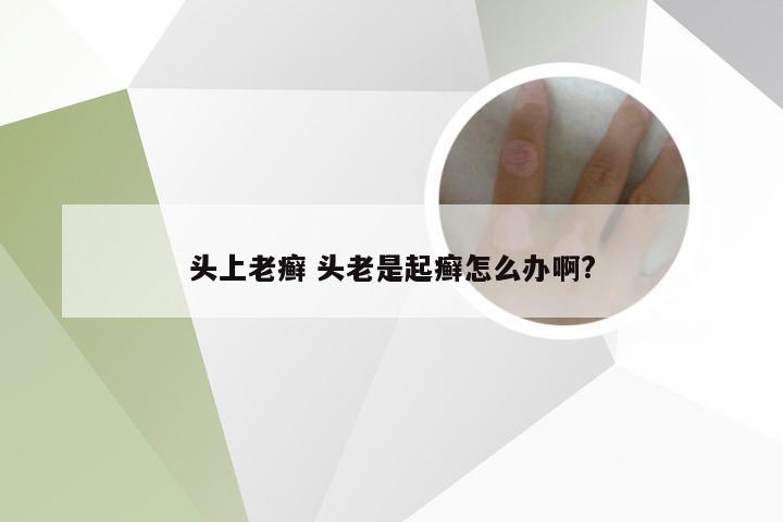 头上老癣 头老是起癣怎么办啊?