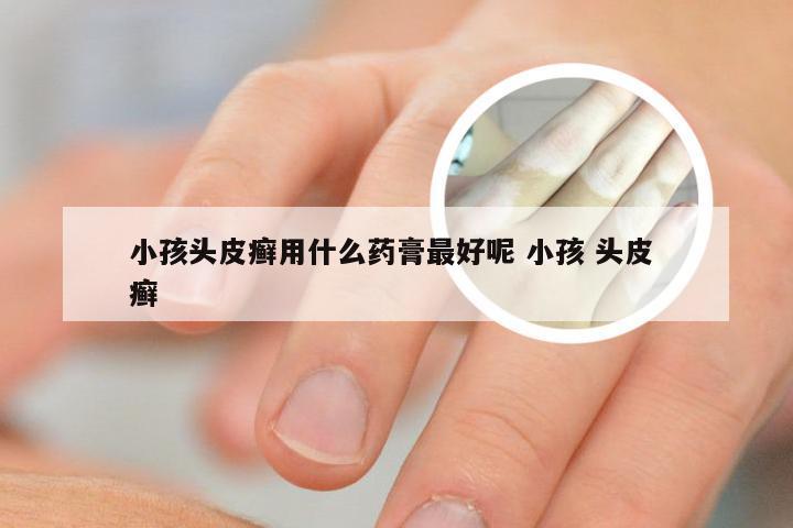 小孩头皮癣用什么药膏最好呢 小孩 头皮 癣