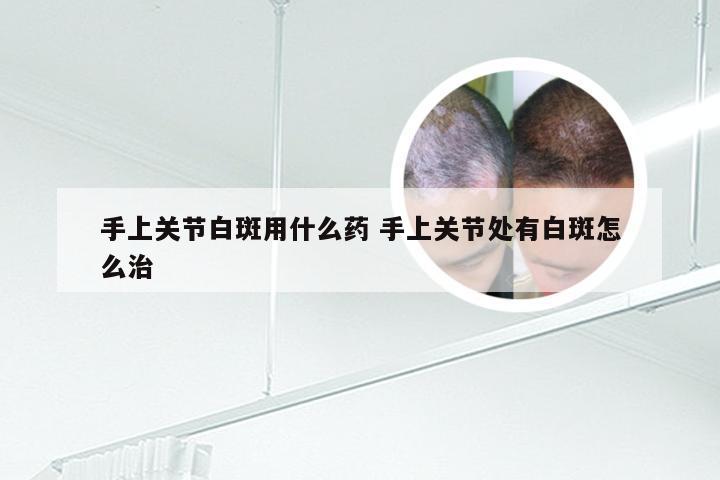 手上关节白斑用什么药 手上关节处有白斑怎么治