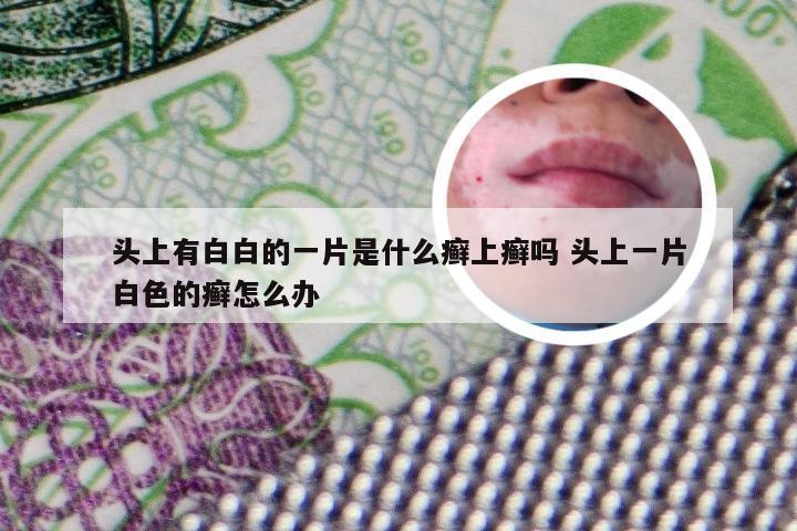 头上有白白的一片是什么癣上癣吗 头上一片白色的癣怎么办