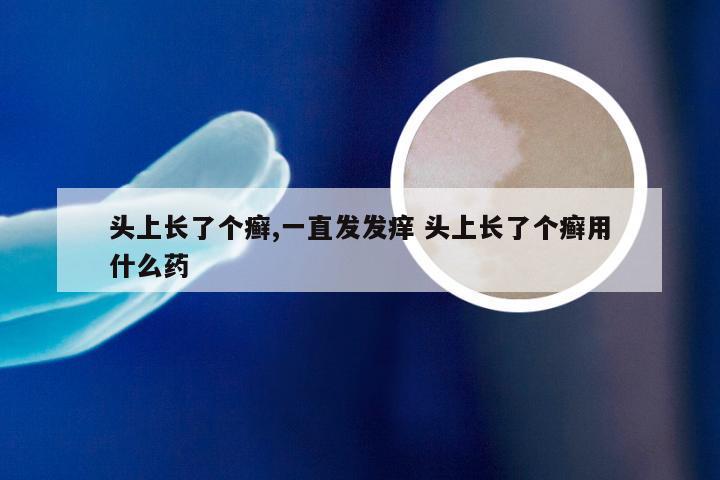 头上长了个癣,一直发发痒 头上长了个癣用什么药