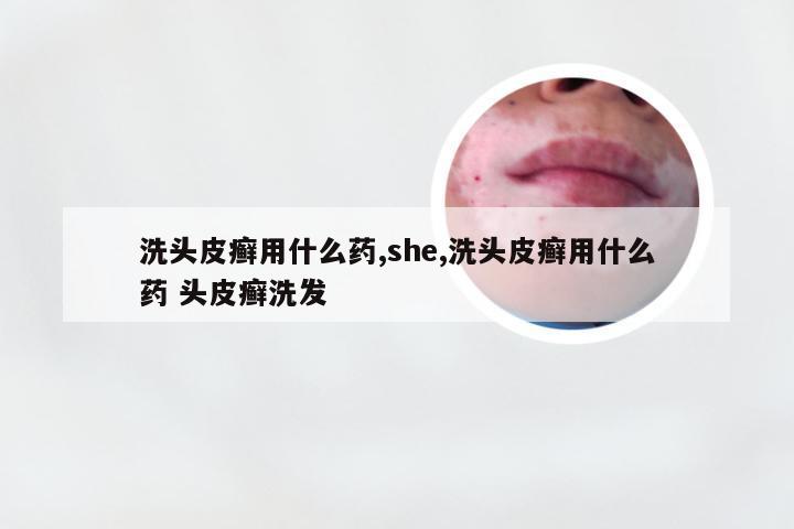 洗头皮癣用什么药,she,洗头皮癣用什么药 头皮癣洗发