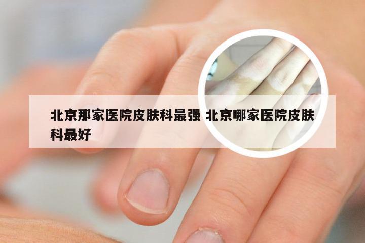 北京那家医院皮肤科最强 北京哪家医院皮肤科最好