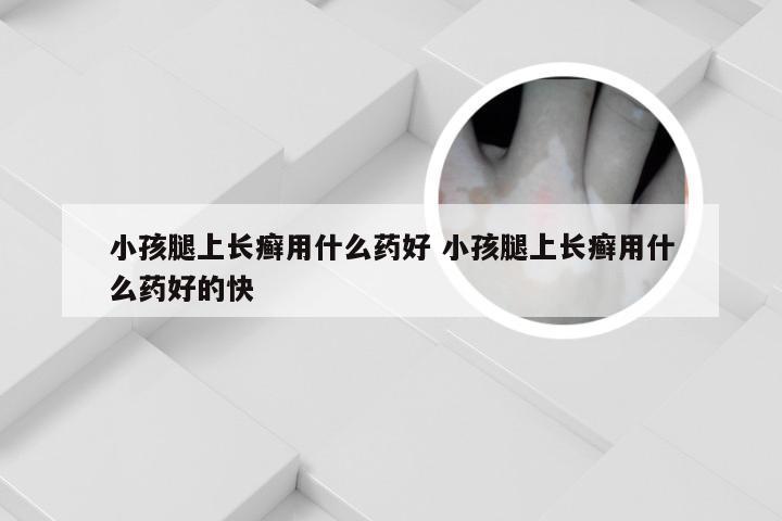 小孩腿上长癣用什么药好 小孩腿上长癣用什么药好的快