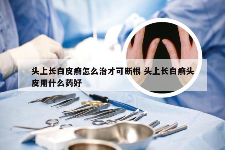 头上长白皮癣怎么治才可断根 头上长白癣头皮用什么药好