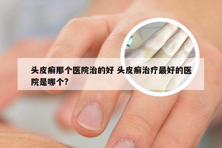 头皮癣那个医院治的好 头皮癣治疗最好的医院是哪个?