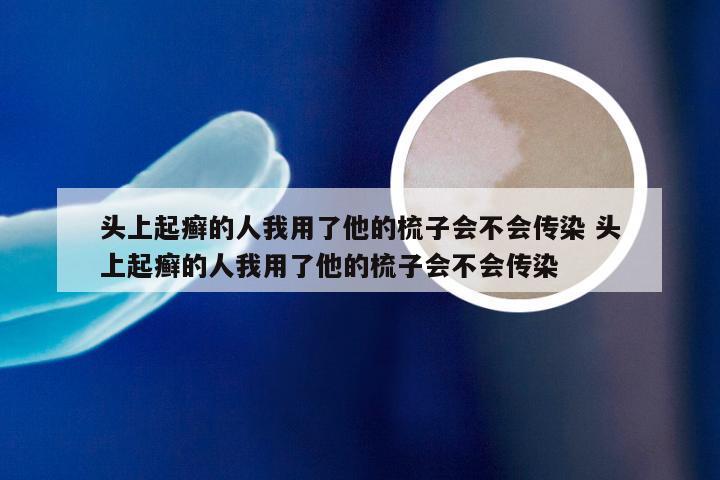 头上起癣的人我用了他的梳子会不会传染 头上起癣的人我用了他的梳子会不会传染