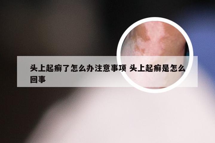 头上起癣了怎么办注意事项 头上起癣是怎么回事