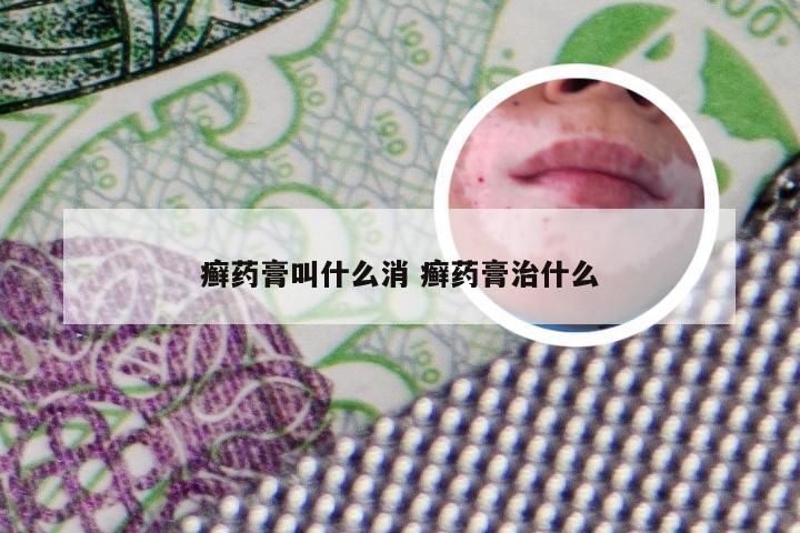 癣药膏叫什么消 癣药膏治什么