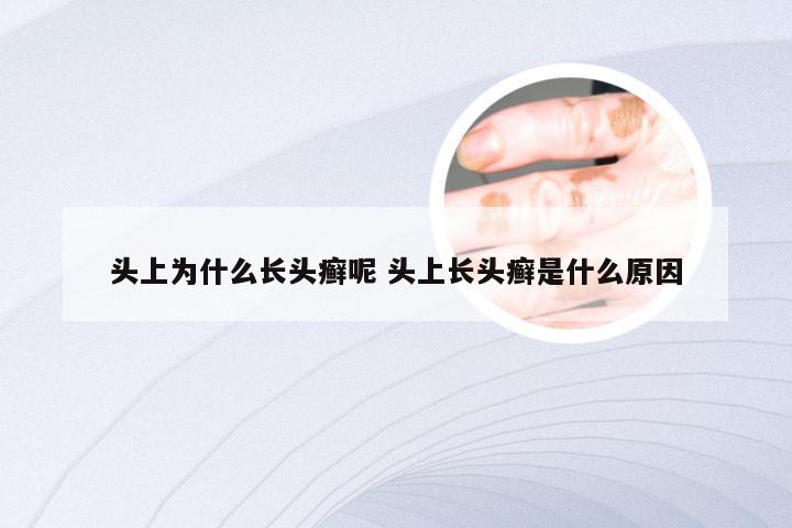 头上为什么长头癣呢 头上长头癣是什么原因