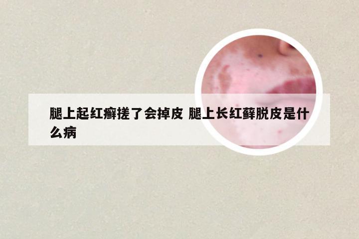 腿上起红癣搓了会掉皮 腿上长红藓脱皮是什么病