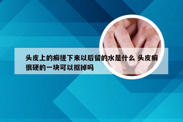 头皮上的癣搓下来以后留的水是什么 头皮癣很硬的一块可以抠掉吗