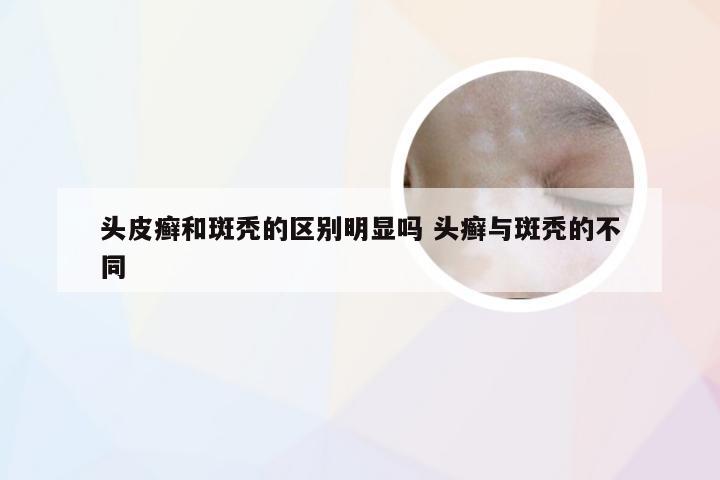 头皮癣和斑秃的区别明显吗 头癣与斑秃的不同