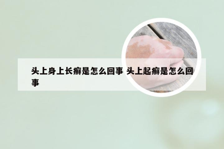 头上身上长癣是怎么回事 头上起癣是怎么回事